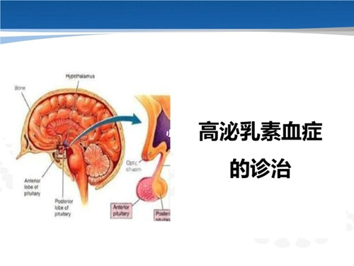 什么是高泌乳素血症？为什么会引起月经失调？