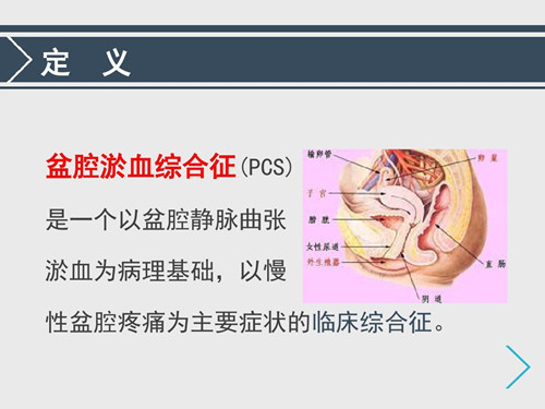 什么是盆腔瘀血综合征？