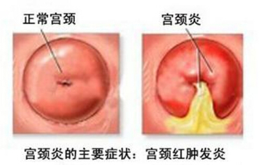 宫颈炎是如何形成的？