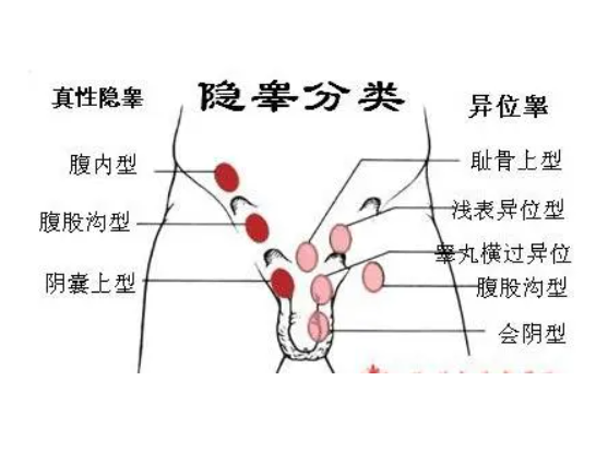 何为隐睾？