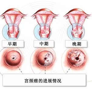 哪些表现应考虑早期宫颈癌？