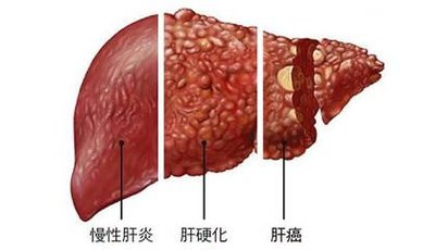 为什么慢性肝炎会发展到肝硬化？