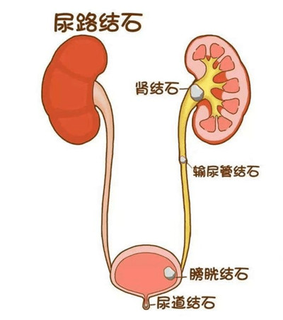 为什么泌尿系结石以肾、输尿管.膀胱、尿道多见