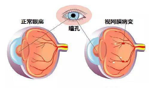 为什么糖尿病易引起视网膜病变？