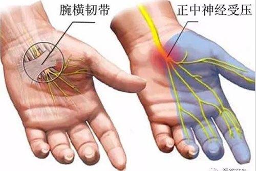 腕管综合征的刮痧治疗方法是什么？