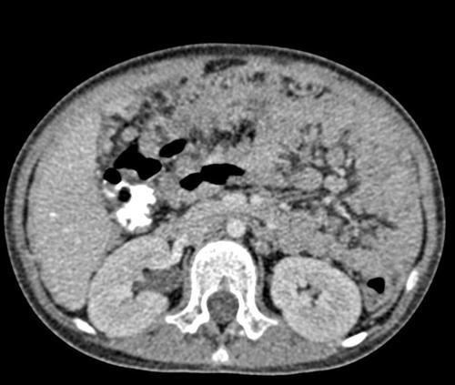 结核性腹膜炎的临床表现如何？