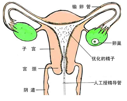 如何进行宫腔内人工授精？