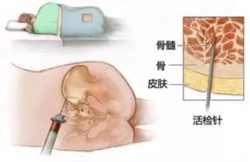 骨髓检查对哪些疾病有诊断意义？