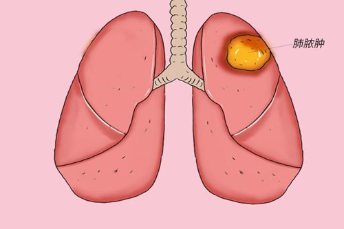 临床上出现哪些症状说明是患了肺脓肿？