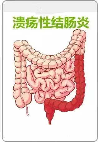 哪些症状提示患了溃疡性结肠炎？