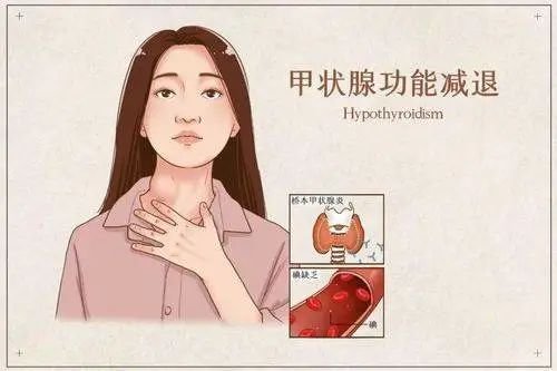 什么是甲状腺功能减退症（甲减）？是由哪些原因引起的？