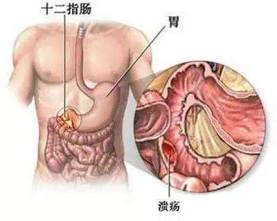 为什么抗酸药能治疗胃、十二指肠溃疡？