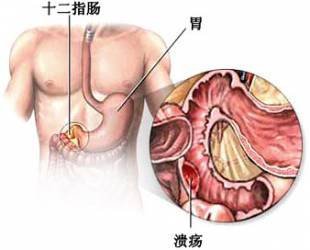 为什么甲氧磺唑用于胃及十二指肠溃疡病的治疗