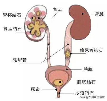 什么是泌尿系统结石？有哪些临床表现？