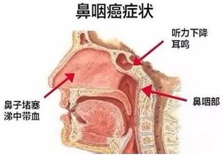 为什么鼻咽癌的发病情况和预后有关？鼻咽癌早期将会出现哪些症状？