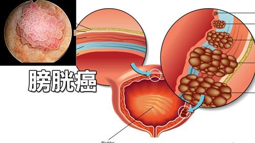 为什么要早期发现膀胱癌？