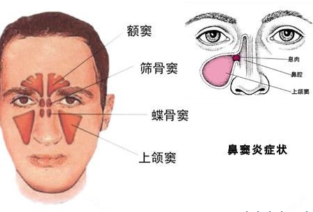 为什么会患鼻窦炎？临床可以分为几类？有哪些症状？