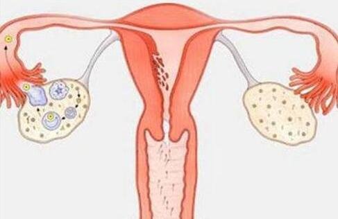多囊卵巢综合征临床表现