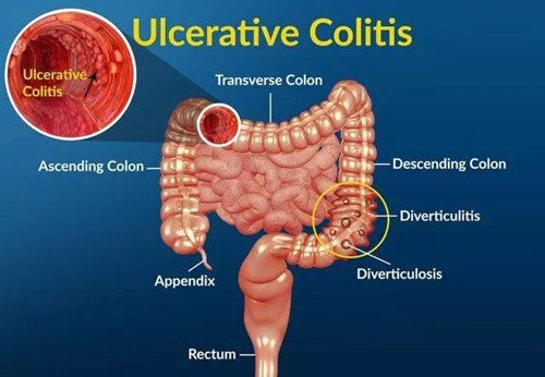 如何治疗溃疡性结肠炎？