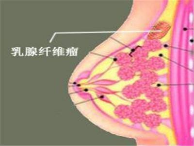 你了解乳腺纤维腺瘤吗？