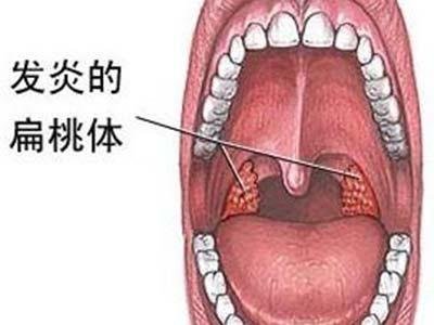 如何治疗急性扁桃体炎？